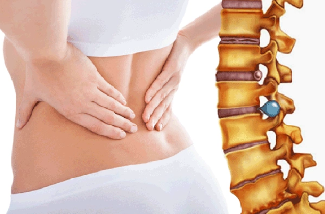 THOÁT VỊ ĐĨA ĐỆM THẮT LƯNG: Nguyên nhân & Cách chữa trị