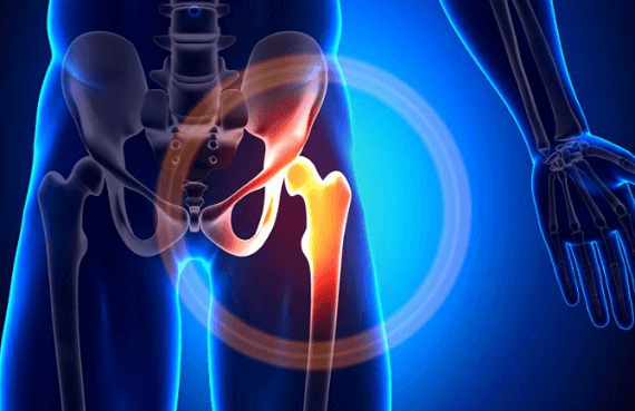 VIÊM KHỚP HÁNG: Nguyên nhân và cách điều trị