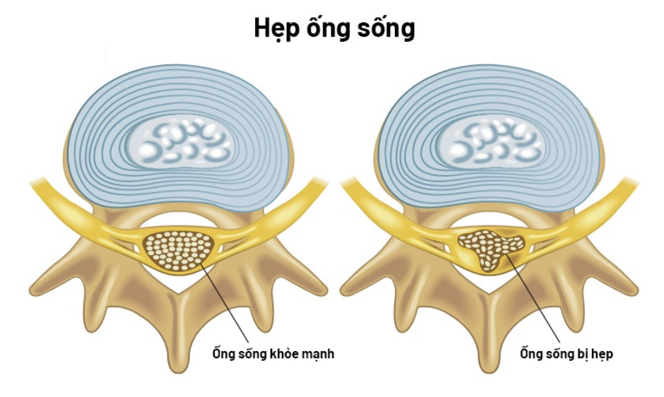 Hẹp ống sống là gì? Những điều cần biết
