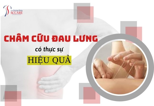 CHÂM CỨU ĐAU LƯNG CÓ THỰC SỰ HIỆU QUẢ?